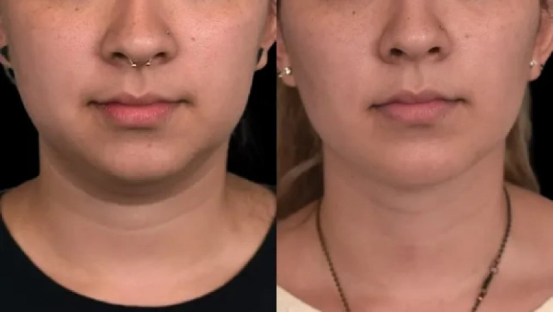 How Double chin removal Surgery in dubai Compares to Other Countries