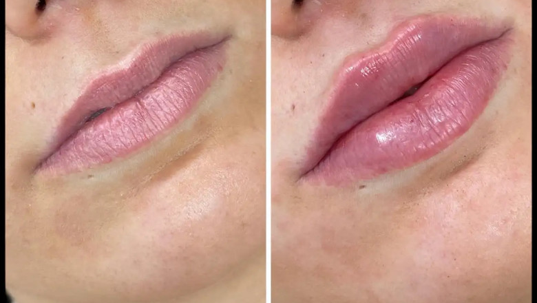 Expert Advice from the Best Doctors in Dubai on Russian Lip Filler Aftercare