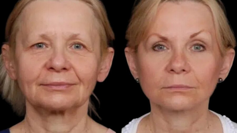 How the Best Doctors in Dubai Evaluate Patients for Under Eye Filler Suitability
