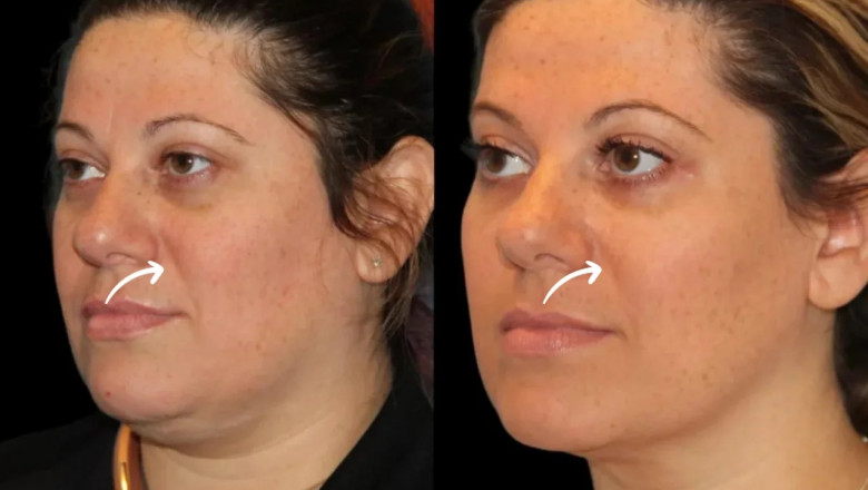 How the Best Doctors in Dubai Use Sculptra Fillers to Sculpt Cheekbones Naturally