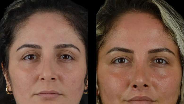 The Best Practices for Cheek Fillers Used by the Best Doctors in Dubai