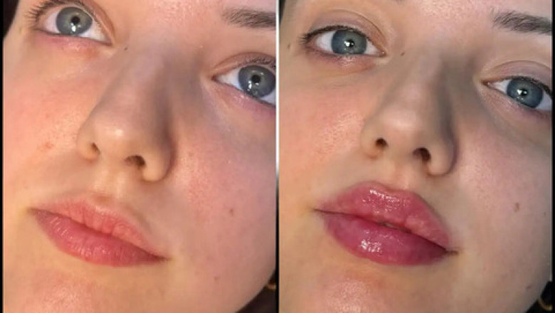 Top 5 Questions to Ask the Best Doctors in dubai for Fillers