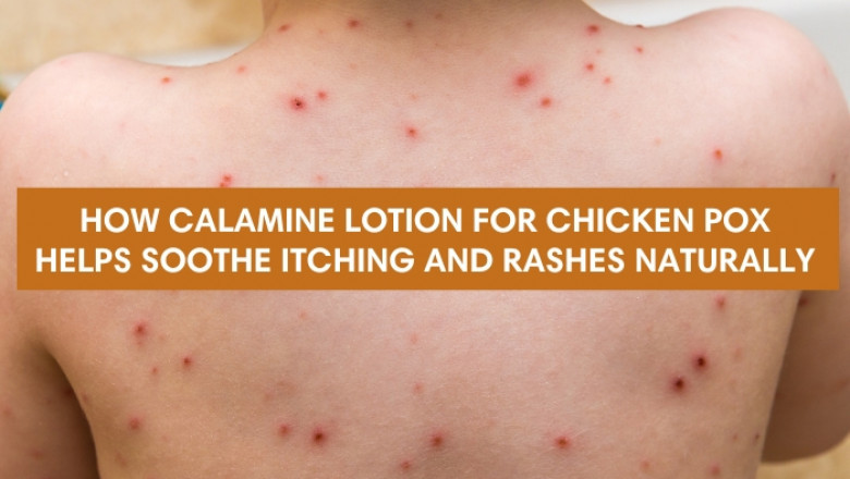 How Calamine Lotion for Chicken Pox Helps Soothe Itching and Rashes Naturally?