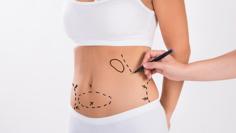 Flawless Body Contouring with Best Liposuction Doctors in Dubai