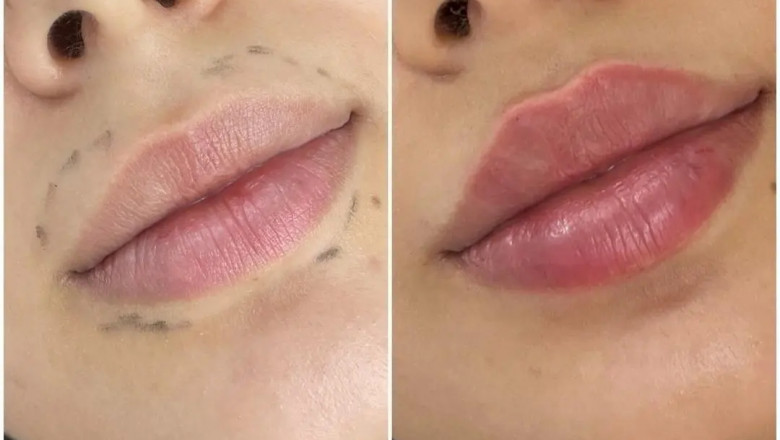 Best Aesthetic Clinics in dubai for Enhancing Facial Features with Dermal Fillers