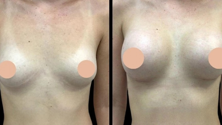 How Safe Is Breast Augmentation in Dubai? Insights from Leading Surgeons