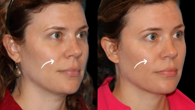 Tips from Dubai’s Best Aesthetic Clinics on Maintaining Long-Term Sculptra Fillers Outcomes