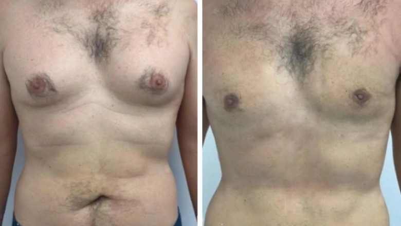 The Future of Gynecomastia in Dubai for better health