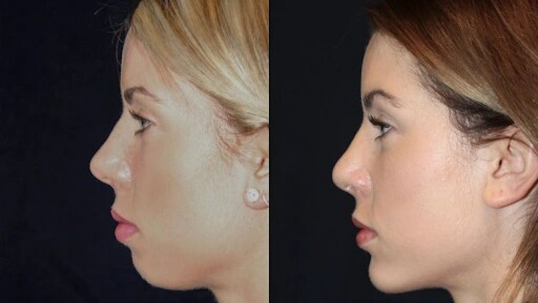 Best Plastic Surgeons in dubai for Chin Fillers: How to Extend Your Results