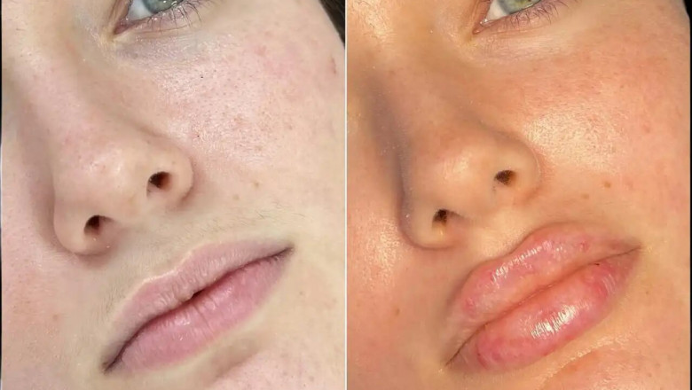 Best Plastic Surgeons in dubai for Fillers: How They Ensure Safety During Surgery