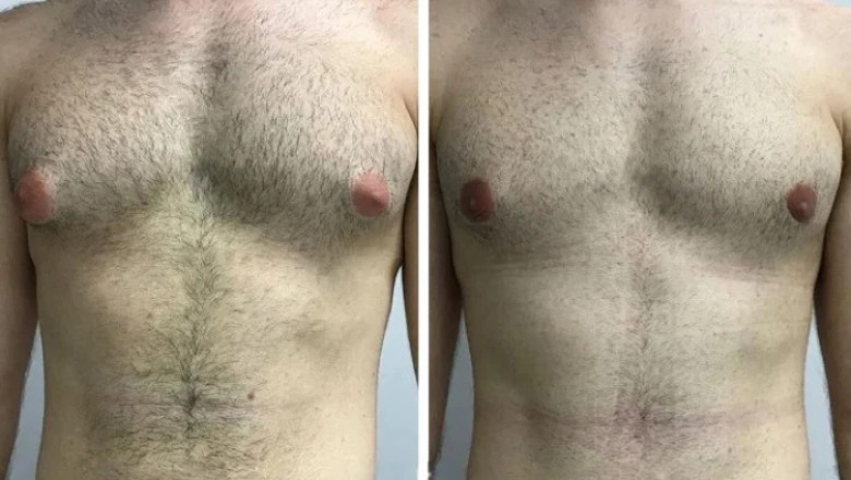 Comparing Gynecomastia Surgery in Dubai with Other Global Destinations