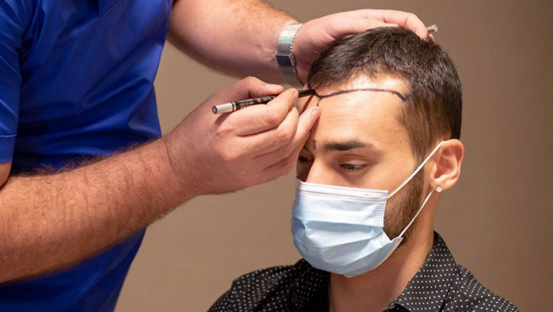 Hair Transplant for Women in Islamabad: What You Need to Know