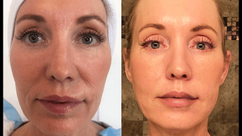 PRP Treatment for face The Role of PRP in Non-Surgical Facelifts