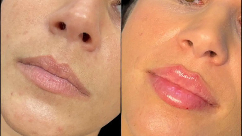 Real Results from the Best Plastic Surgeon in Dubai for Fillers