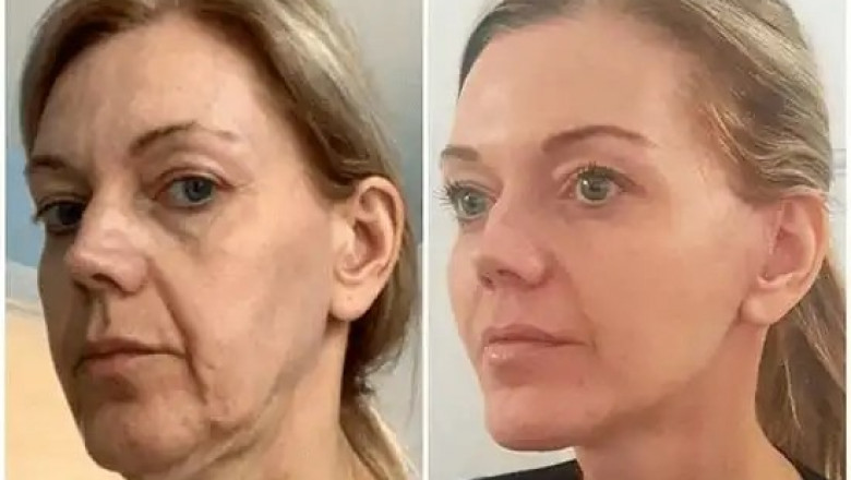 Trigger Radiance via the Best Plastic Surgeon in dubai Using Profhilo