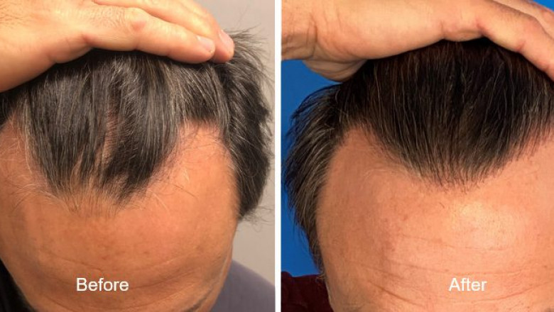 Why UK Patients Are Choosing DHI Hair Restoration Albania for Lasting Results