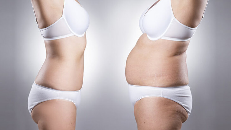 Tummy Tuck Surgery in Delhi -Dr Rajat Gupta