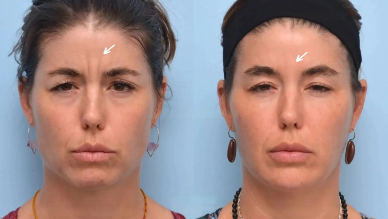 Best Aesthetic Clinic in Dubai: Botox Aftercare Tips for Long-Lasting Results