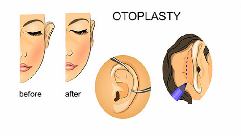 Otoplasty Surgery in Delhi - Dr Rajat Gupta