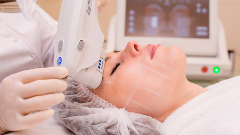 Pre-Wedding HIFU Treatment in Islamabad