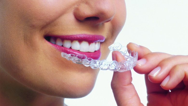 Do’s and Don’ts While Wearing Invisalign Aligners