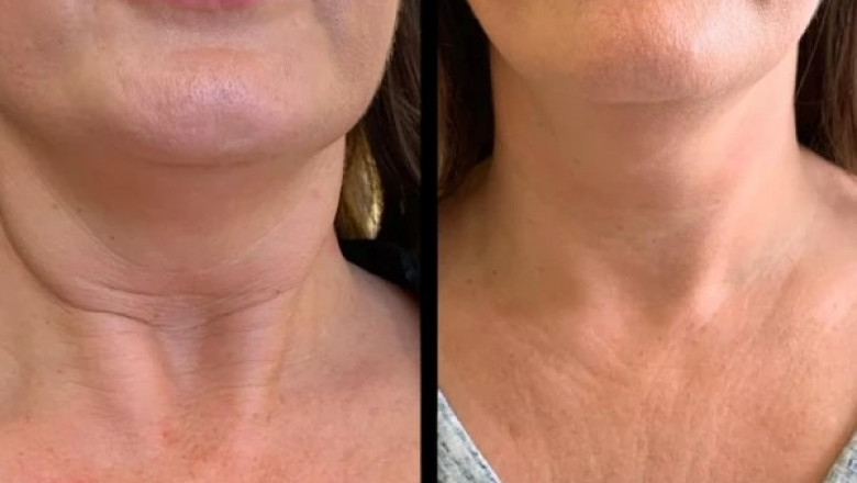 Best Plastic Surgeons in dubai Recommend Profhilo Glow