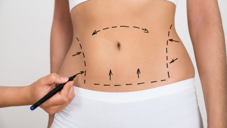 Recovery Meets Results Discover Best Liposuction Doctors in Dubai Today