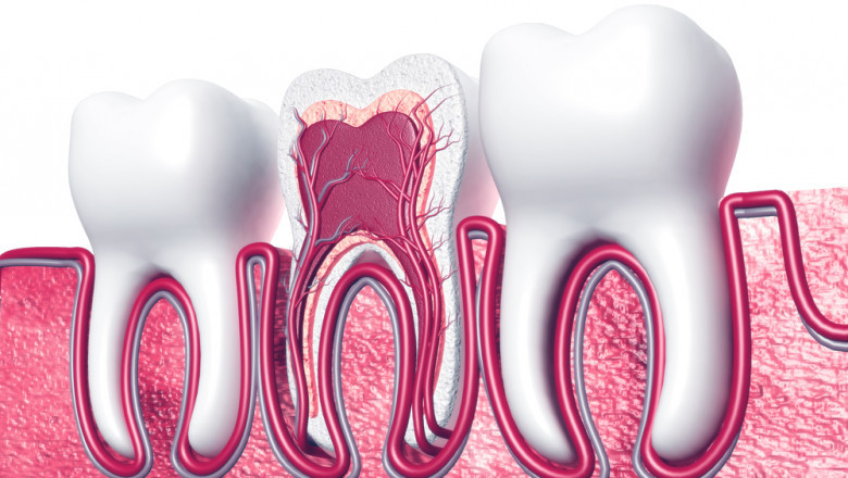 Rising Demand for Root Canal in Islamabad: 2025 Trends