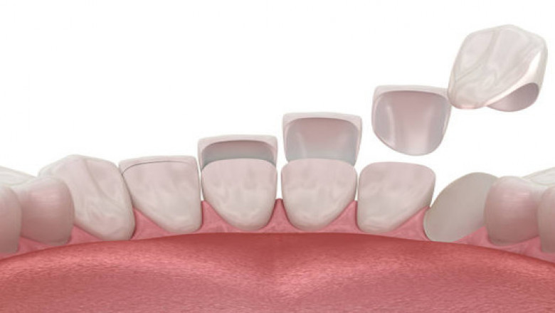 What Is a Composite Restoration? A Simple Guide for Patients