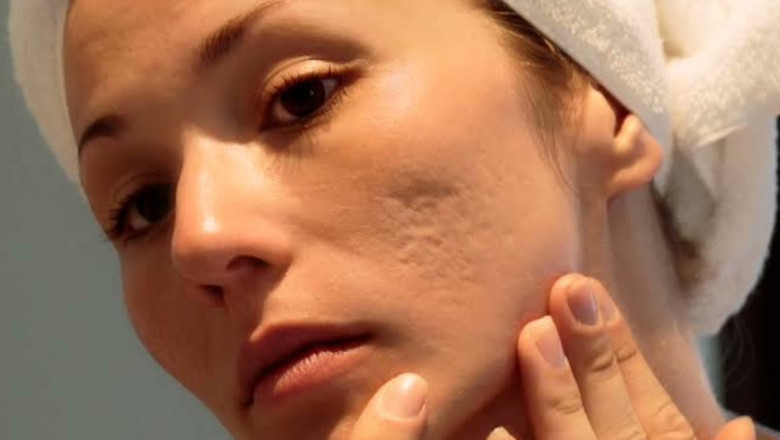 What Foods Help Heal Acne Scars Faster in Islamabad?