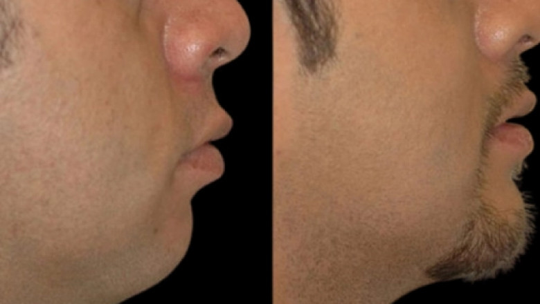 Signs You May Need Double chin removal in Dubai
