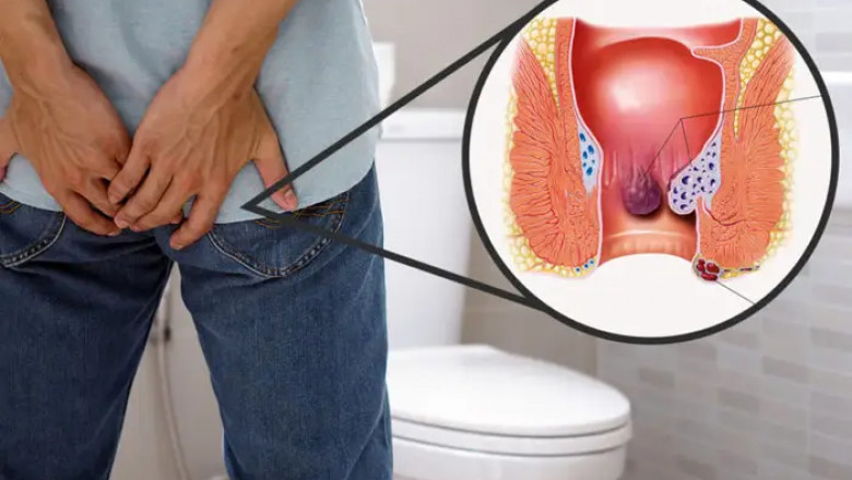 How to Choose the Right Doctor for Piles Treatment in Vadodara?