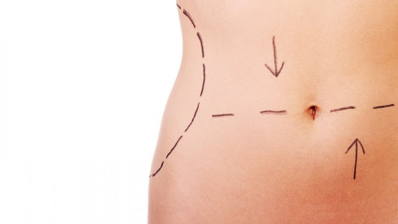 AI in Planning Tummy Tuck in Islamabad