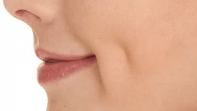 Dimple Creation vs. Chin Dimple: What Should You Choose?