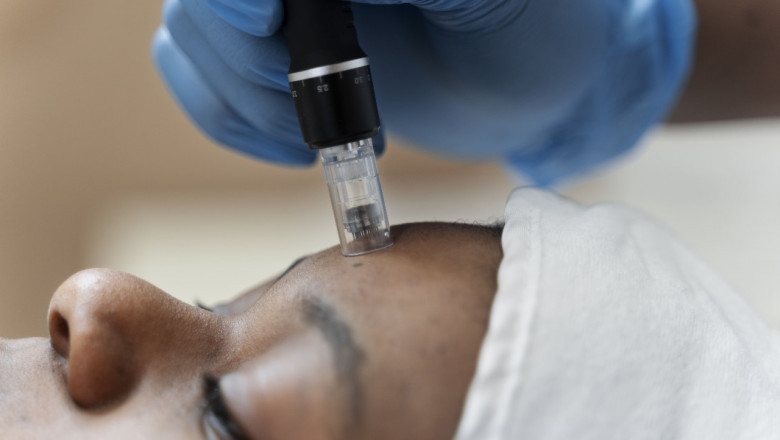 Microneedling Mississauga