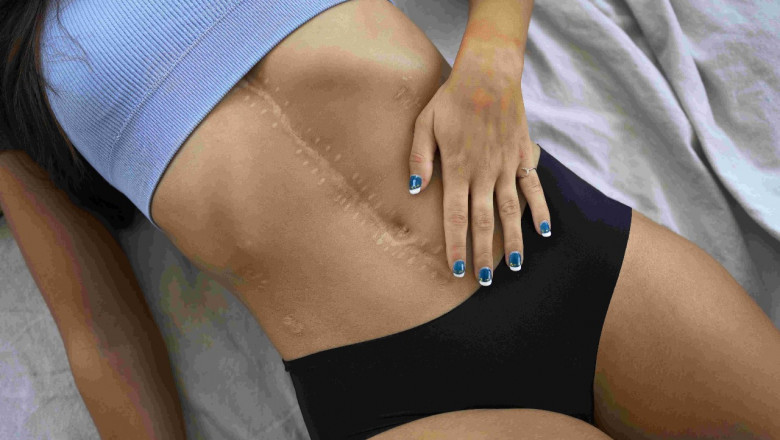 Scar Removal Mississauga