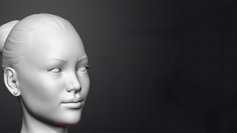 What is Facial Feminization Surgery for the Chin?