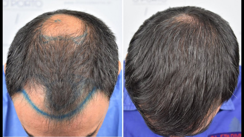 How Crown Hair Transplant Boosts Confidence: A New Outlook on Life Through Hair Restoration