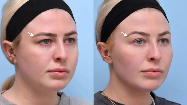 The Best Aesthetic Clinics in Dubai for Botox: A Non-Surgical Solution to Aging
