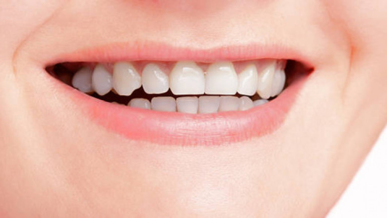 How Long Does Tooth Reshaping Take—and Is It Safe?