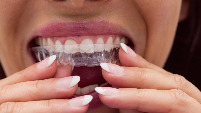 Smile Makeover: Benefits of Veneers in Tampa, FL