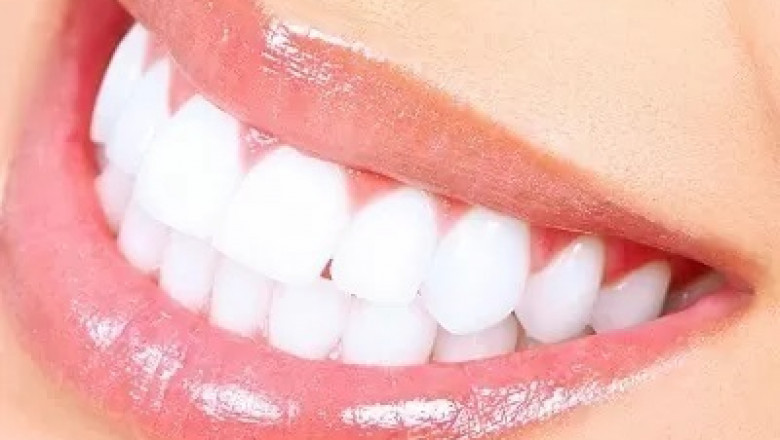 Step-by-Step Guide to Laser Teeth Whitening in Islamabad