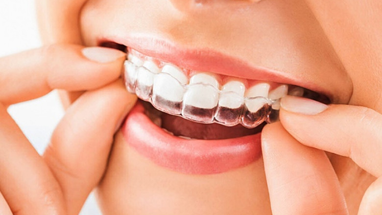 Top 5 Benefits of Getting Teeth Braces Early in Life