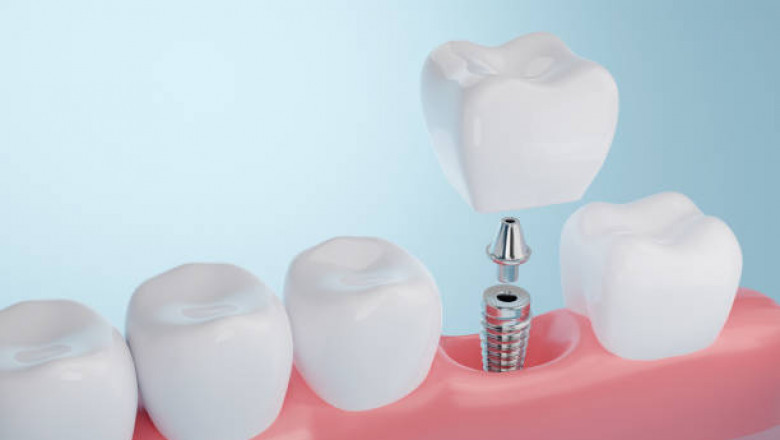 What Happens If You Don’t Replace a Missing Tooth