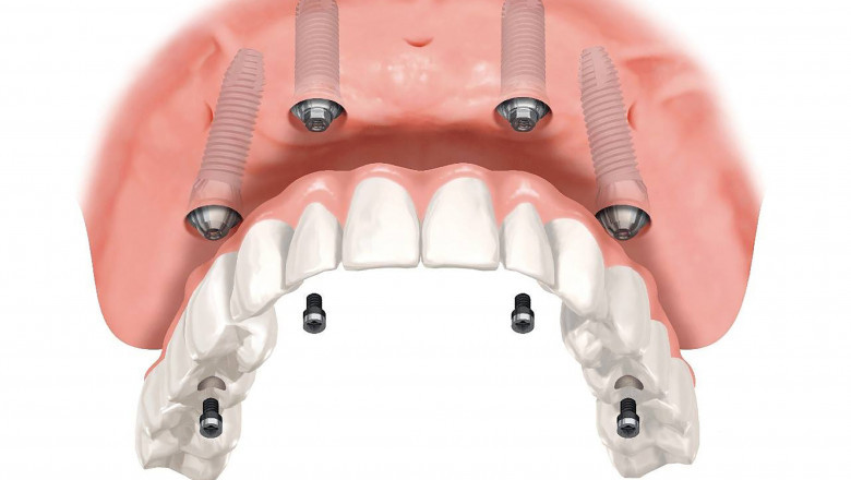 Todo lo que debes saber sobre los implantes dentales 4 en 6