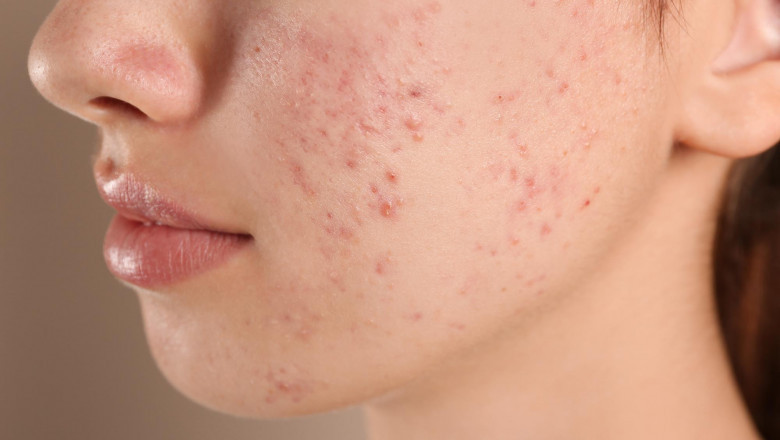 The Real Causes of Acne: Hormones, Diet, and Stress