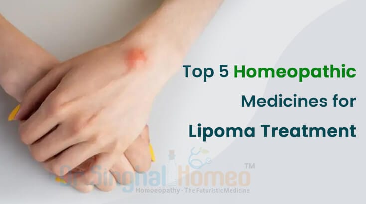 5 Top Homeopathic Remedies for Lipoma