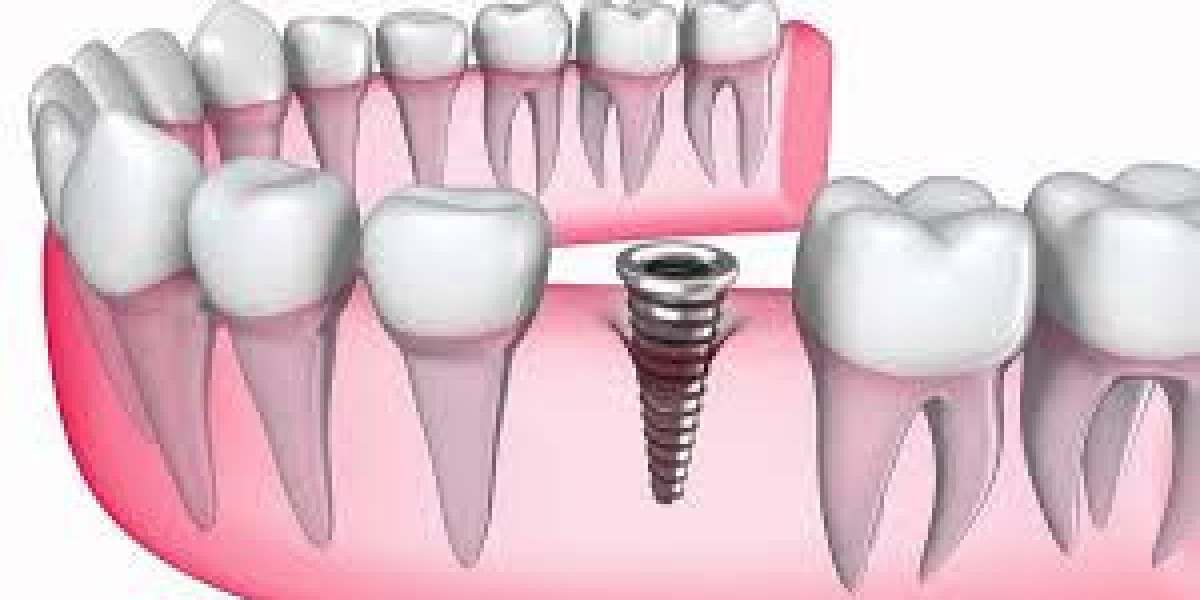 Trồng răng sứ thực chất là lắp răng sứ trong quy trình trồng răng implant