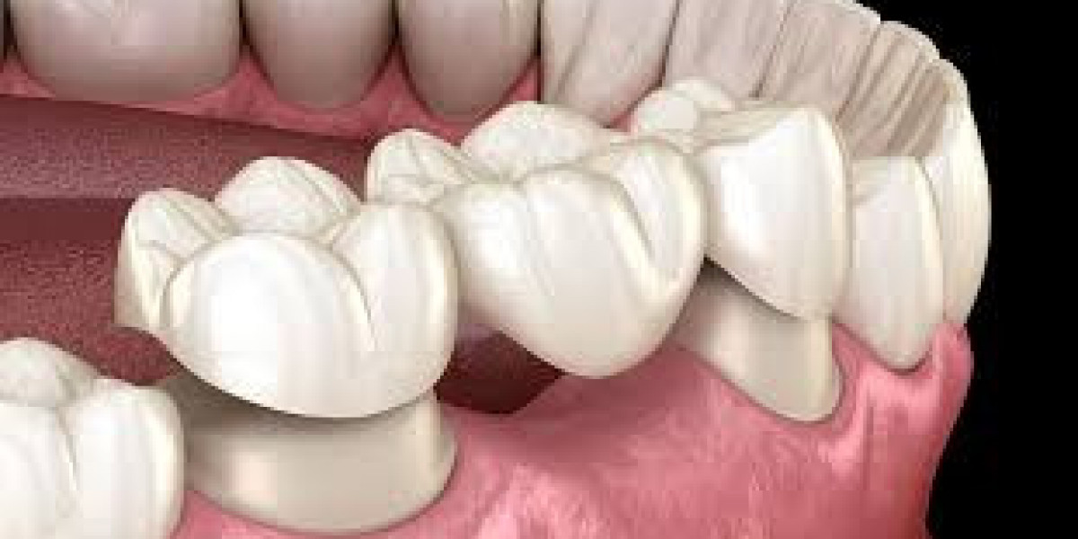 Is a Dental Bridge the Right Solution for Your Missing Teeth?