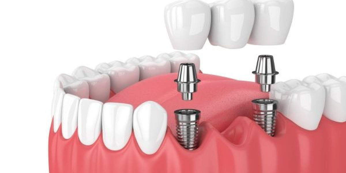 Cắm implant có đau không? Địa chỉ uy tín giúp bạn yên tâm điều trị